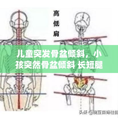 儿童突发骨盆倾斜,小孩突然骨盆倾斜 长短腿