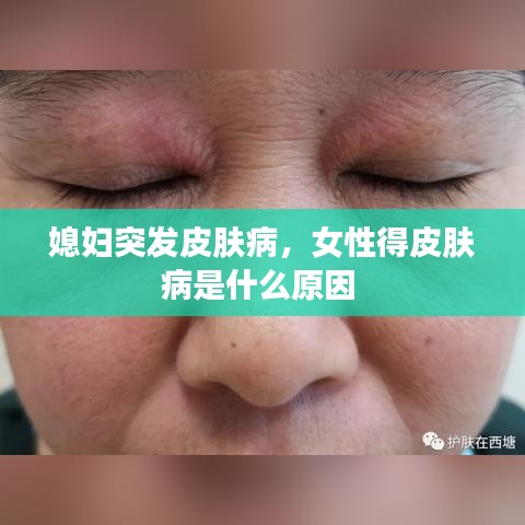 媳妇突发皮肤病,女性得皮肤病是什么原因