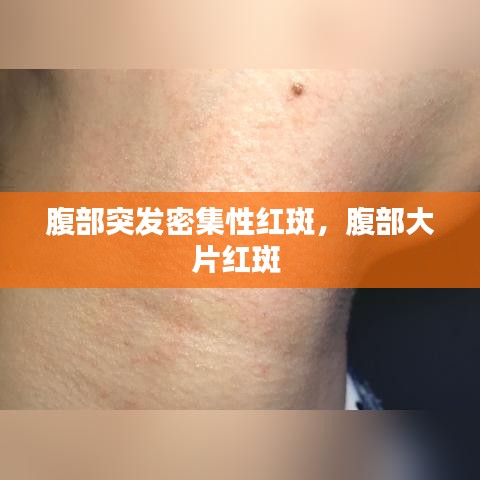 腹部突发密集性红斑，腹部大片红斑 